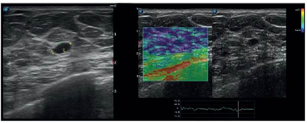 No se observa se&ntilde;al Doppler color y es de consistencia dura en la elastograf&iacute;a.