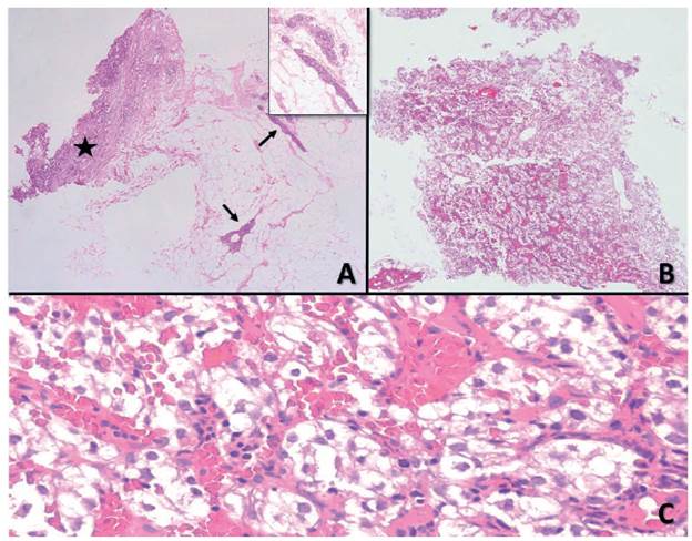 Histopatolog&iacute;a. Se observa par&eacute;nquima mamario (flecha) (A, H&E, 4x) comprometida por una proliferaci&oacute;n de c&eacute;lulas grandes con citoplasmas amplios claros y n&uacute;cleos hipercrom&aacute;ticos con ocasionales nucl&eacute;olos prominentes, escaso pleomorfismo y figuras de mitosis; adicionalmente, se identifican &aacute;reas de hemorragia difusa (A, H&E 4x, estrella) (B, H&E, 4x) (C, H&E, 40x).