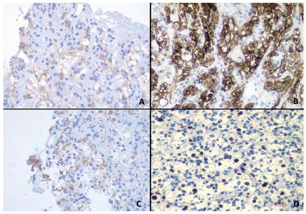 Inmunohistoqu&iacute;mica. Se observa positividad focal tenue para carcinoma de c&eacute;dulas renales (RCC, de renal cell carcinoma) (A, 40x); positividad fuerte y difusa para CD10 (B, 40x); positividad tenue de membrana para CK (citoqueratina) (C,40x); &iacute;ndice de proliferaci&oacute;n (Ki67) de 30 % (D,40x).