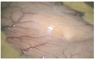 Tumor del estroma gastrointestinal hacia la curvatura mayor del est&oacute;mago identificado en la laparoscopia.