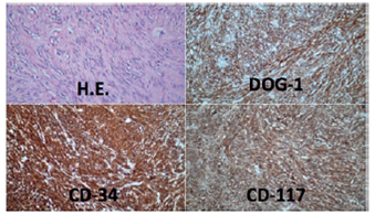Inmunohistoqu&iacute;mica de las piezas quir&uacute;rgicas con marcadores positivos para DOG-1, CD-34 y CD- 117, indicativos de tumor del estroma gastrointestinal.
