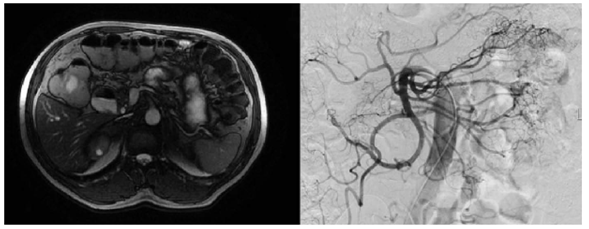 Enterorresonancia y arteriograf&iacute;a en las que no se observan alteraciones.