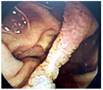 Imagen de la c&aacute;psula endosc&oacute;pica en la que se aprecia el tabique que separa la duplicaci&oacute;n tubular de la luz verdadera del duodeno.