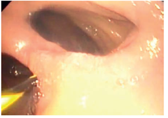 Imagen endosc&oacute;pica en la que se observa el tabique que separa la duplicaci&oacute;n tubular (con una gu&iacute;a en su luz) de la luz duodenal verdadera.