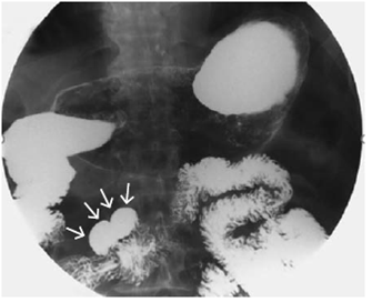 V&iacute;as digestivas altas en las que se evidencia la duplicaci&oacute;n tubular localizada en la tercera porci&oacute;n del duodeno (flechas).