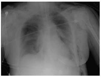 Neumot&oacute;rax derecho con enfisema subcut&aacute; neo y neumomediastino.