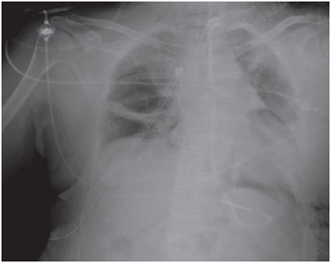 Periodo posoperatorio inmediato: adecuada expansi&oacute;n pulmonar con algunas atelectasias laminares.