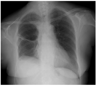 Radiograf&iacute;a de control a los 6 meses del pe riodo posoperatorio que evidencia adecuada expansi&oacute;n pulmonar.