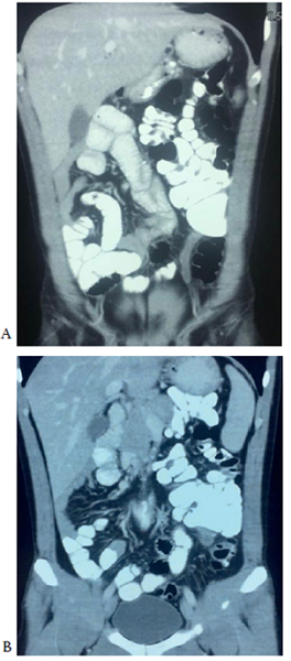A y B. Tomografía axial con contraste de abdo men (vista coronal): (A) se evidencian asas intestinales delgadas (yeyuno e íleon) en el hemiabdomen derecho. La válvula ileocecal se encuentra en la fosa iliaca iz quierda, el apéndice cecal está aumentado de tamaño e hipodenso, sin captación del medio de contraste, con un diámetro aproximado de 7,3 mm en la punta, 7,5 mm en la base y 7,2 mm en el tercio medio. (B) Hígado, bazo y estómago en su sitio. Asas del intestino delgado y ángulo de Treitz a la derecha. Colon a la izquierda. Base del muñón del apéndice grueso, con ausencia de captación del medio de contraste.