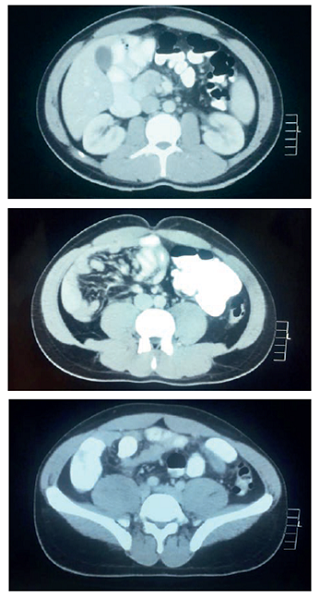 Tomografía axial con contraste de abdomen (vista transversal): se evidencian hígado y bazo en posición habitual. Asas intestinales delgadas y ángulo de Treitz en hemiabdomen derecho. El colon se ubica en el hemiabdomen izquierdo. No se aprecia el apéndice.