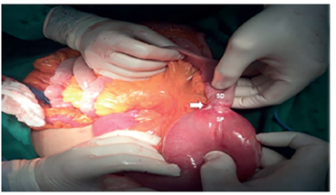Lesión transoperatoria