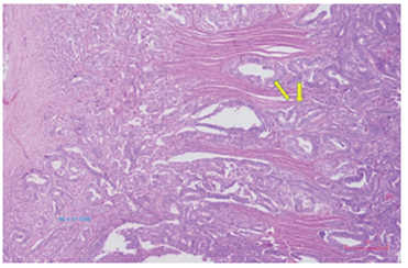 Proliferación glandular desordenada con glándulas de tamaños variables; epitelio atípico, caracterizado por pérdida de la polaridad, pleomorfismo nuclear, nucleomegalia y mitosis abundante. Hematoxilina eosina, 100X.