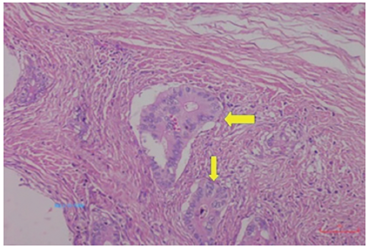 Patrón infiltrante con formación de figuras (back to back), cribas y ausencia de estroma fibrovascular entre las glándulas neoplásicas. Hematoxilina y eosina, 100X.