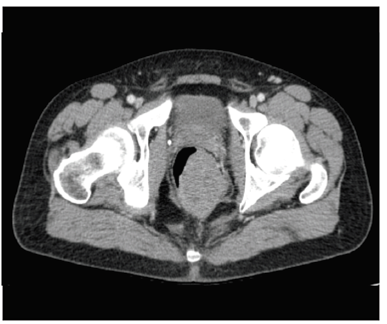 TC abdominal en la que se observa masa rectal de 73 x 62 x 48 mm, sin una clara afectaci&oacute;n de la grasa perirrectal, y sin identificarse un plano graso de separaci&oacute;n del suelo prost&aacute;tico.