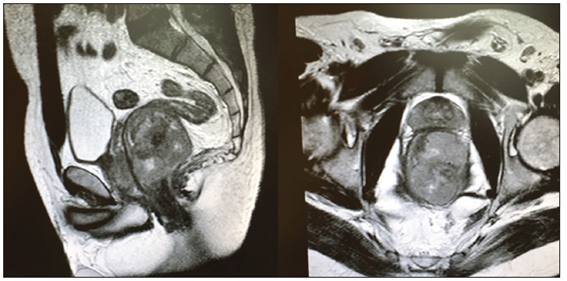 RM p&eacute;lvica, en la que se observa borramiento en el lateral rectal izquierdo, sugestiva de un GIST.