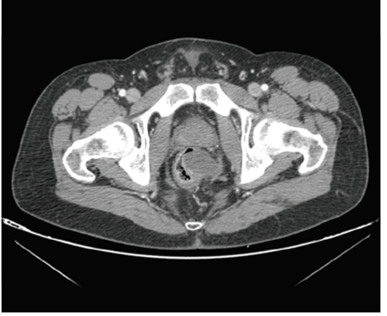 Disminuci&oacute;n considerable del volumen tumoral despu&eacute;s de la administraci&oacute;n de imatinib, quedando el tumor por encima de la reflexi&oacute;n peritoneal.