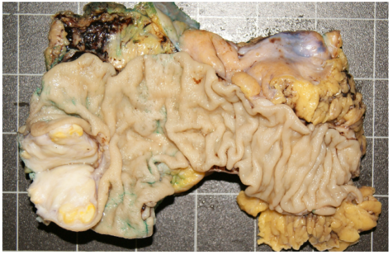 Pieza de anatom&iacute;a patol&oacute;gica en el que se observa resecci&oacute;n de recto, con focos microsc&oacute;picos residuales de tumor del estroma gastrointestinal.