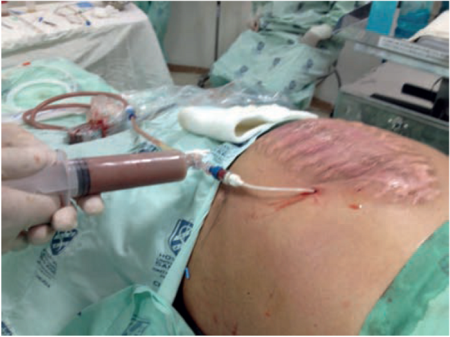 Drenaje guiado por TC de una necrosis pancreática infectada posterior a necrosectomía abierta.