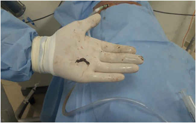 Fragmento de necrosis pancreática infectada.