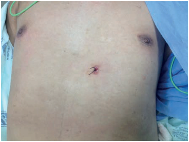 Cicatriz del drenaje transgástrico por necrosis pancreática infectada.