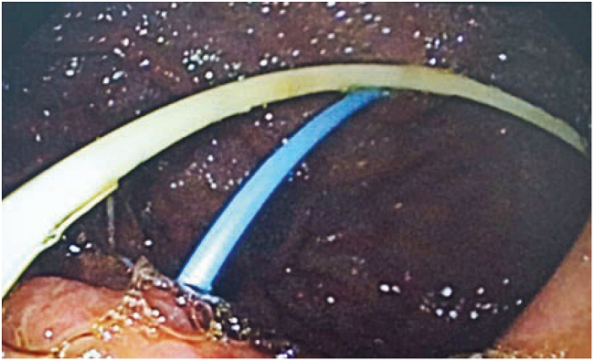Colocación de catéter doble J transgástrico percutáneo.