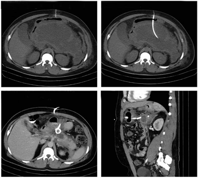 Drenaje percutáneo transgástrico de pseudoquiste pancreático.