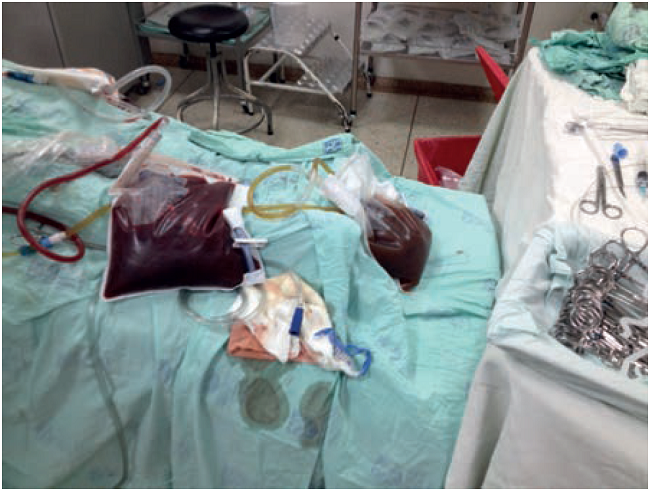 Hemorragia posquirúrgica de quistes hepáticos.