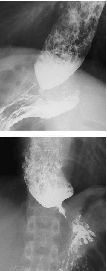 Esofagograma: aspecto t&iacute;pico de &lsquo;pico de p&aacute;jaro&rsquo;.