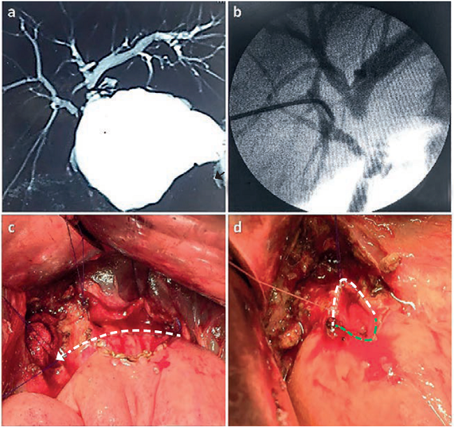 a) Colangiorresonancia magnética: lesión quirúrgica de la vía biliar con pérdida de la confluencia de los conductos hepáticos y bilioma subhepático. b) Colangiografía intraoperatoria: separación entre ambos conductos hepáticos de 2 o más cm. c) Apertura amplia del conducto hepático izquierdo; la línea punteada muestra el plano de sutura posterior de la hepático - yeyuno anastomosis y la flecha señala el conducto hepático derecho. d) Anastomosis entre el conducto hepático derecho (línea blanca) y el yeyuno (línea verde).