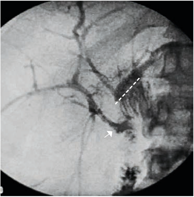 Colangiografía posoperatoria de control: permeabilidad de la anastomosis bilioentérica derecha (flecha) y la izquierda (línea punteada).