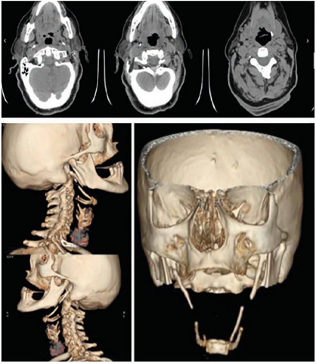 Tomograf&iacute;a computarizada de cuello con reconstrucci&oacute;n tridimensional en donde se observa la osificaci&oacute;n del complejo estilohioideo.