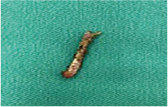 Pieza osificada extra&iacute;da.