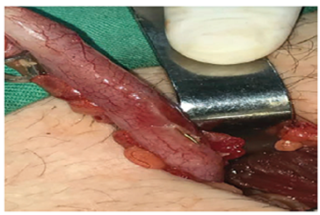 Apéndice cecal con congestión, perforación en su tercio proximal y el cuerpo extraño.