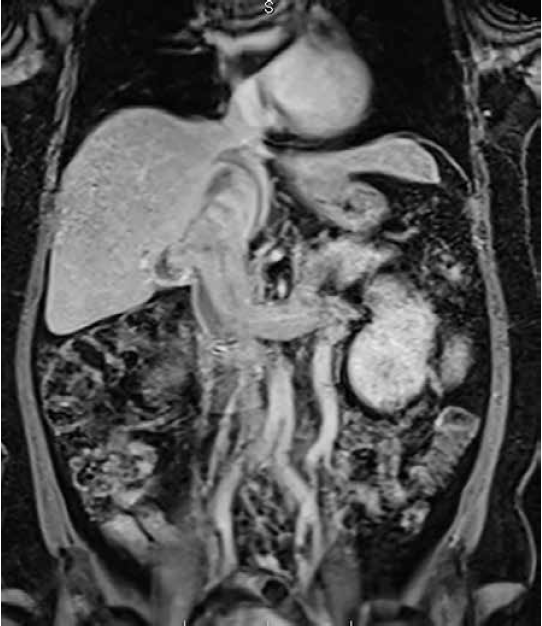 Corte coronal de resonancia magn&eacute;tica contrastada con gadolinio: tumor renal izquierdo con trombo de tipo Neves III, oclusi&oacute;n total de la vena renal izquierda y de la vena cava inferior retrohep&aacute;tica, con hipertensi&oacute;n venosa, m&uacute;ltiples colaterales y gran dilataci&oacute;n de la vena gonadal izquierda.