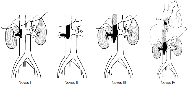 Clasificaci&oacute;n de Neves-Zincke: Neves I, compromete la vena renal; Neves II, el trombo se extiende hasta la vena cava inferior infrahep&aacute;tica; Neves III, el trombo se extiende por la vena cava inferior retrohep&aacute;tica; Neves IV, el trombo llega hasta la aur&iacute;cula.
			            Reproducido con permiso de: Neves RJ, Zincke H. Surgical treatment of renal cancer with vena cava extension. Br J Urol. 1987;59:390-5.