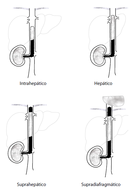 Subclasificaci&oacute;n de trombos Neves III: IIIa, intrahep&aacute;tico, sin llegar a las venas suprahepaticas,; IIIb, hep&aacute;tico: se extiende hasta el ostium de las venas suprahep&aacute;ticas; IIIc, suprahep&aacute;tico: el trombo supera el ostium de las venas suprahep&aacute;ticas; Illd, supradiafragm&aacute;tica: el trombo atraviesa el diafragma, pero sin comprometer la aur&iacute;cula derecha. 
					    Reproducido con permiso de: Ciancio G, Vaidya A, Savoie M, Soloway M. Management of renal cell carcinoma with level III thrombus in the inferior vena cava. J Urol. 2002;168(4Pt1):1374-7.