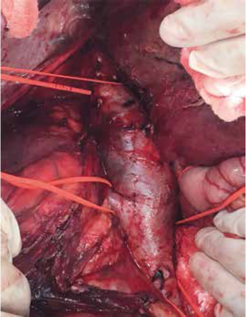Disecci&oacute;n completa de la vena cava inferior retrohep&aacute;tica; reparos proximal y distal al trombo, adem&aacute;s de las venas renales.