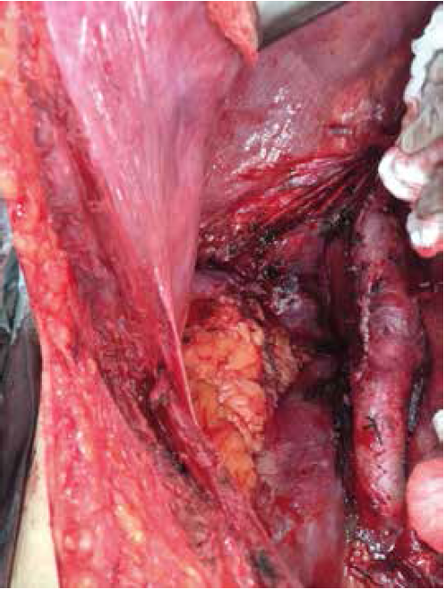 Sutura en dos planos de la vena cava inferior retrohep&aacute;tica, con polipropileno 4.0.