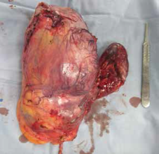 Ri&ntilde;&oacute;n derecho con trombo de vena cava inferior de tipo Neves IIIa, en bloque.