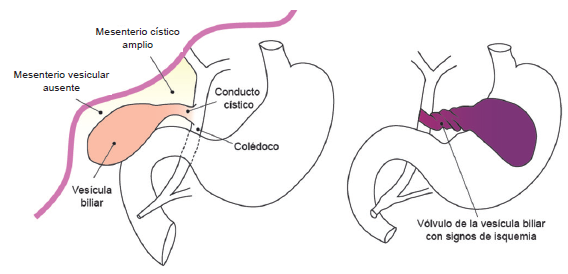 Se ilustra la torsi&oacute;n mayor de 180&deg; de la ves&iacute;cula biliar sobre el conducto c&iacute;stico, que compromete su irrigaci&oacute;n.