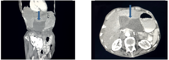 Paciente 1. Tomograf&iacute;a computadorizada de abdomen en la que se observa ves&iacute;cula biliar distendida, con una ubicaci&oacute;n diferente a la usual (flecha).