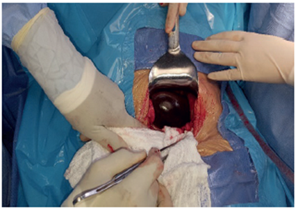 Se aprecia el v&oacute;lvulo de la ves&iacute;cula biliar, con compromiso vascular (isqu&eacute;mico) al practicar la laparotom&iacute;a exploradora.