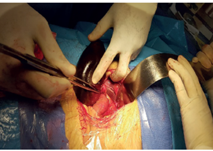 Correcci&oacute;n del v&oacute;lvulo de la ves&iacute;cula biliar; se observa mesenterio c&iacute;stico amplio, m&oacute;vil, y ves&iacute;cula biliar flotante sin mesenterio en el lecho hep&aacute;tico.