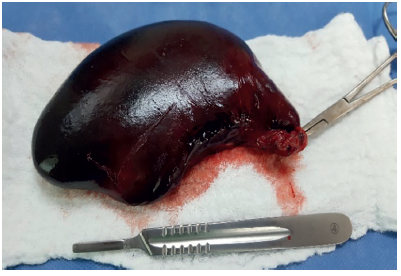 Ves&iacute;cula biliar extirpada, distendida, con colecistitis isqu&eacute;mica (infarto) debida a la torsi&oacute;n sobre su eje.