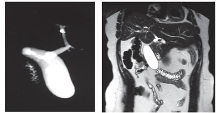 Paciente 2. Colangiorresonancia magn&eacute;tica en la que se observa ves&iacute;cula biliar subhep&aacute;tica izquierda.