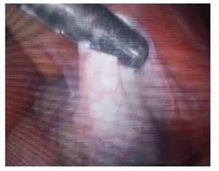 &lsquo;Sinistraposici&oacute;n&rsquo; de la ves&iacute;cula biliar en el lecho hep&aacute;tico izquierdo sin situs inverso ni signos de inflamaci&oacute;n.