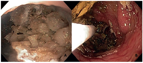 A. En el reservorio g&aacute;strico, el bezoar de coco ocasiona una obstrucci&oacute;n g&aacute;strica parcial. B. En el yeyuno, el asa endosc&oacute;pica pasa por la anastomosis gastroyeyunal despu&eacute;s de la extracci&oacute;n del bezoar.