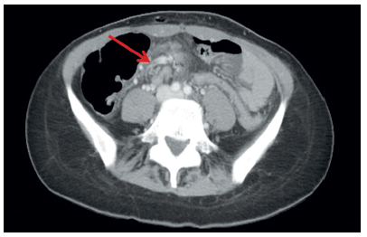 Se observan los vasos arteriales arremolinados alrededor de la base del pedículo mesentérico. Este es el signo del remolino, visible en la tomografía computarizada cuando la malrotación intestinal se asocia con vólvulo del intestino delgado.