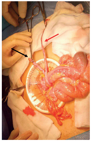 Se señalan el apéndice cecal en el hipocondrio derecho (flecha negra) y una brida insertada en el mesocolon derecho (flecha roja).