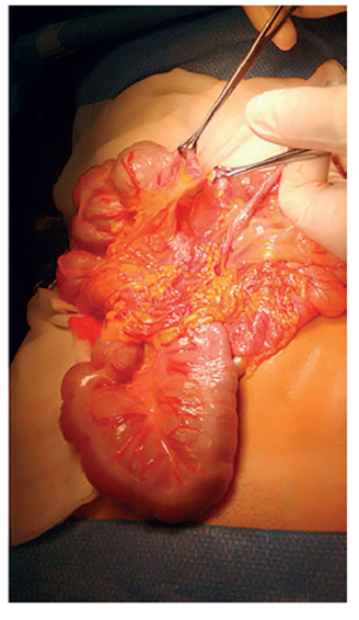 Después de seccionar la brida, se observan el ciego y el colon sigmoide en el hemiabdomen derecho; el ciego, con su apéndice, se encuentran en el hipocondrio derecho.